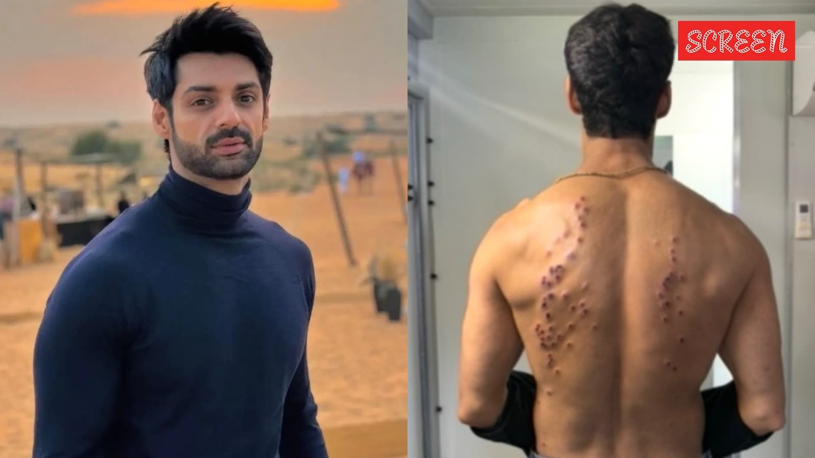 Karan Wahi shows severe bruises from Khatron Ke Khiladi 15 pellets task: ‘Scariest season’