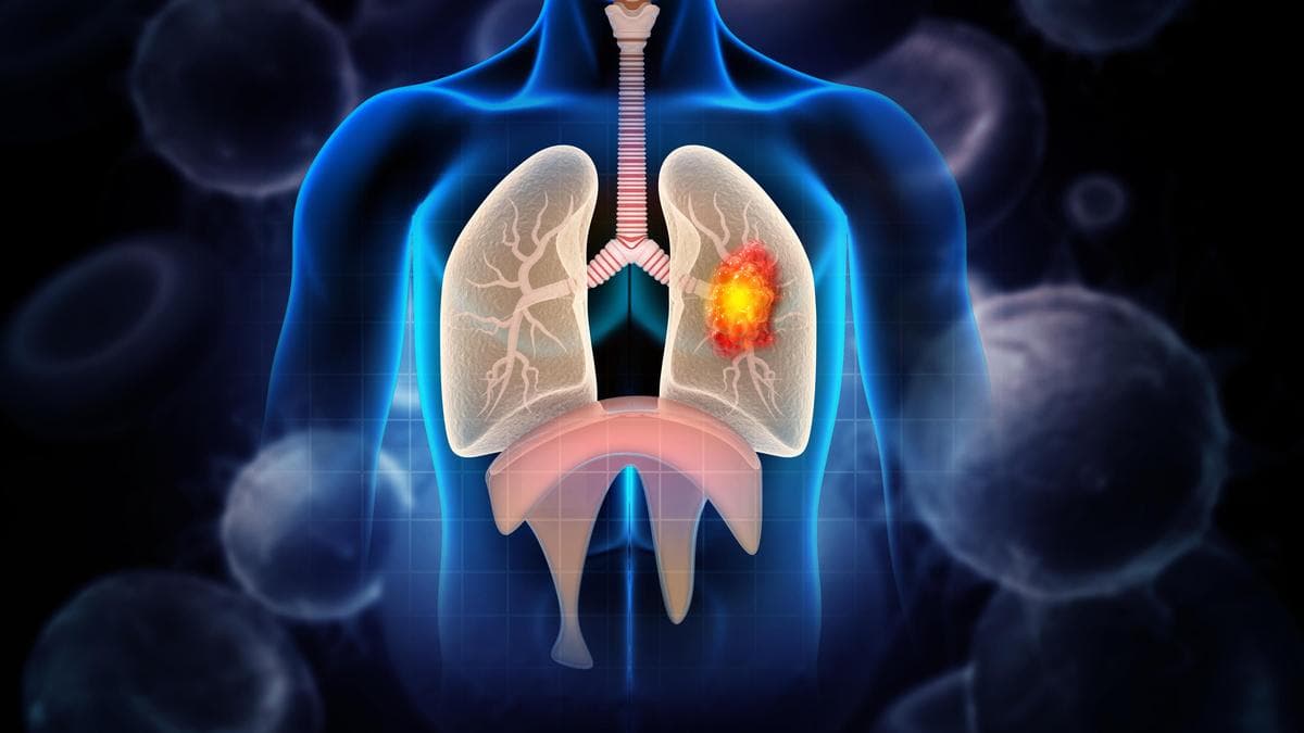 Lung cancer accounts for 6% of cancer cases in Karnataka; tobacco remains biggest risk factor